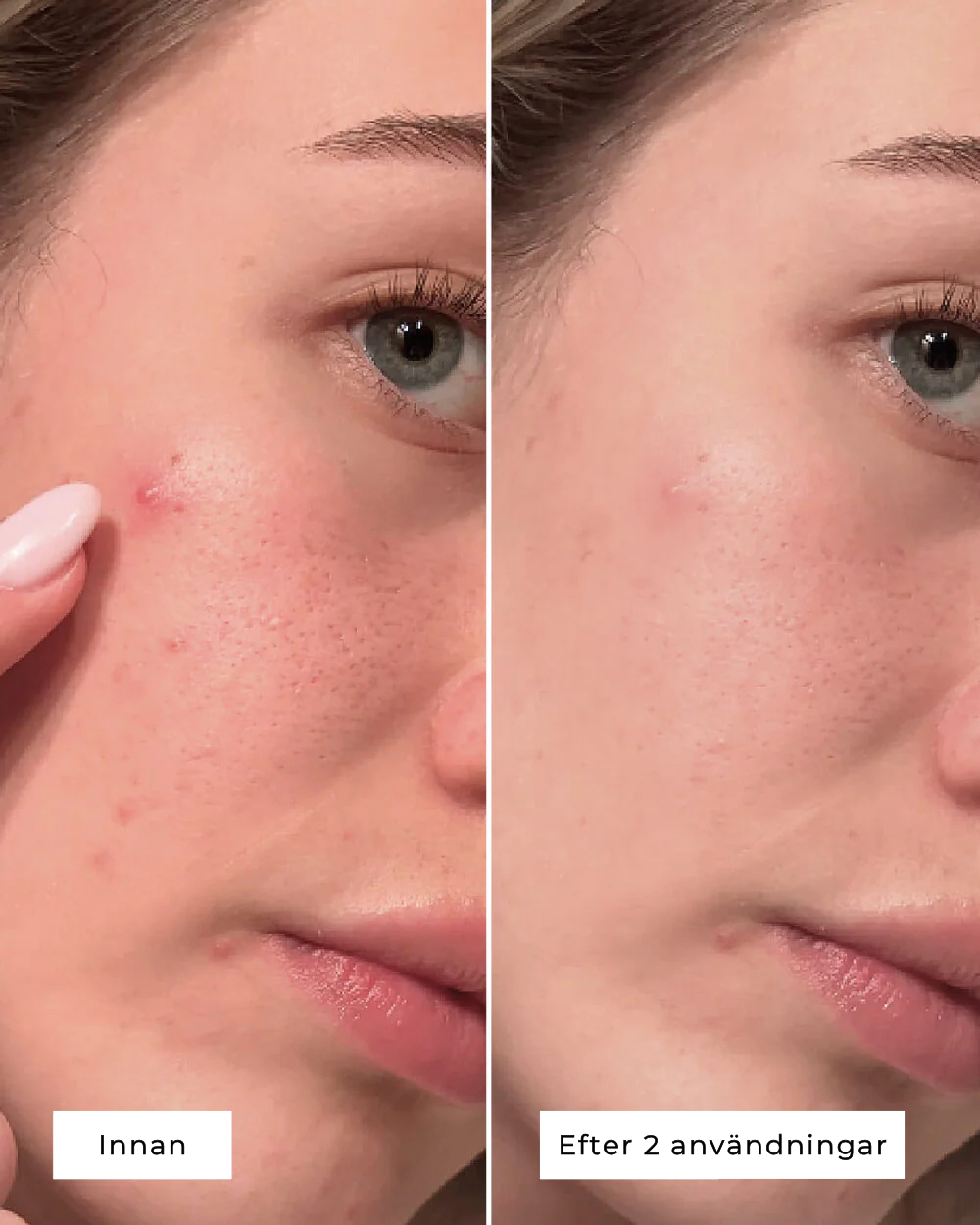 CLEAR SPOT PATCHES