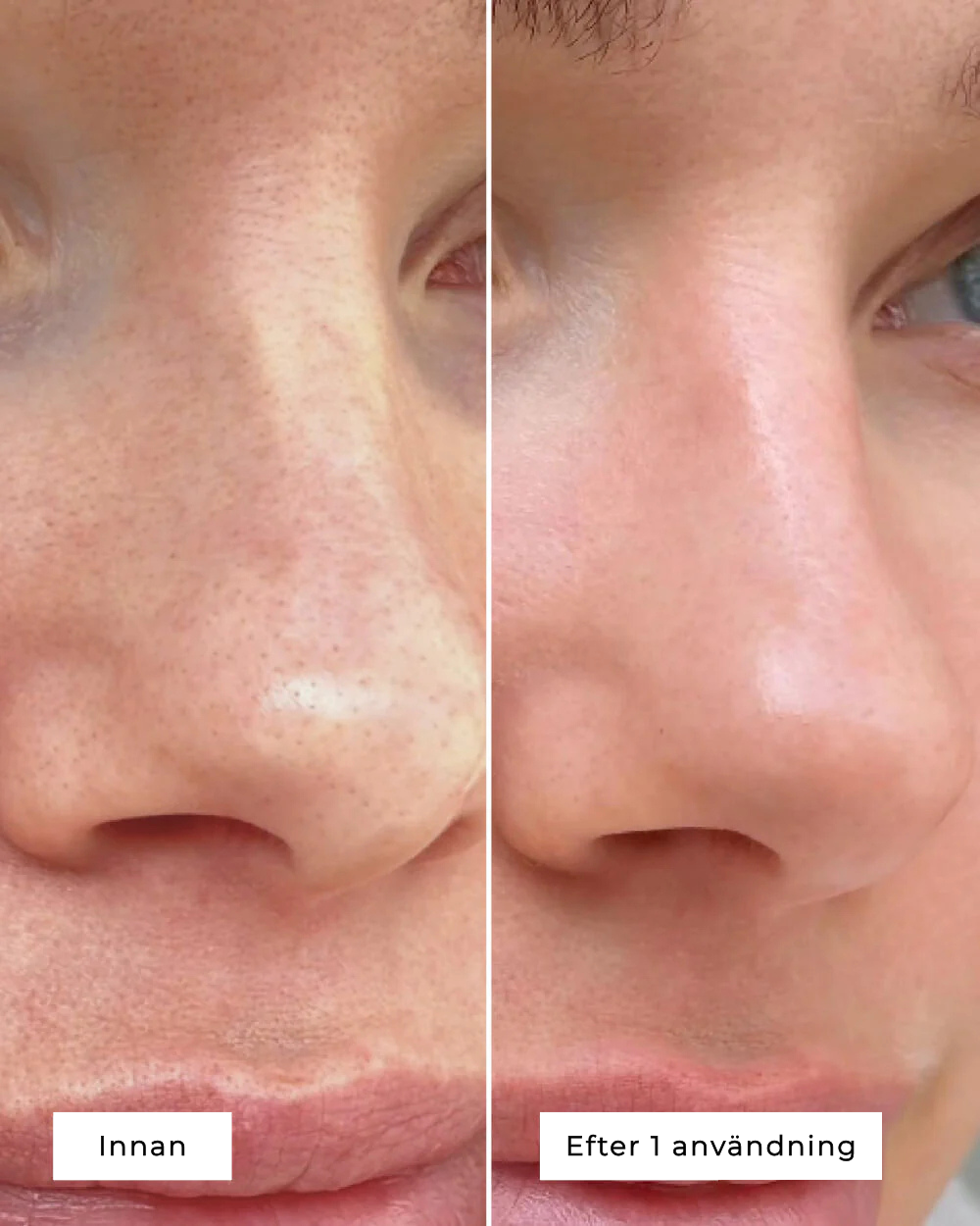 SALICYLIC ACID EXFOLIANT
