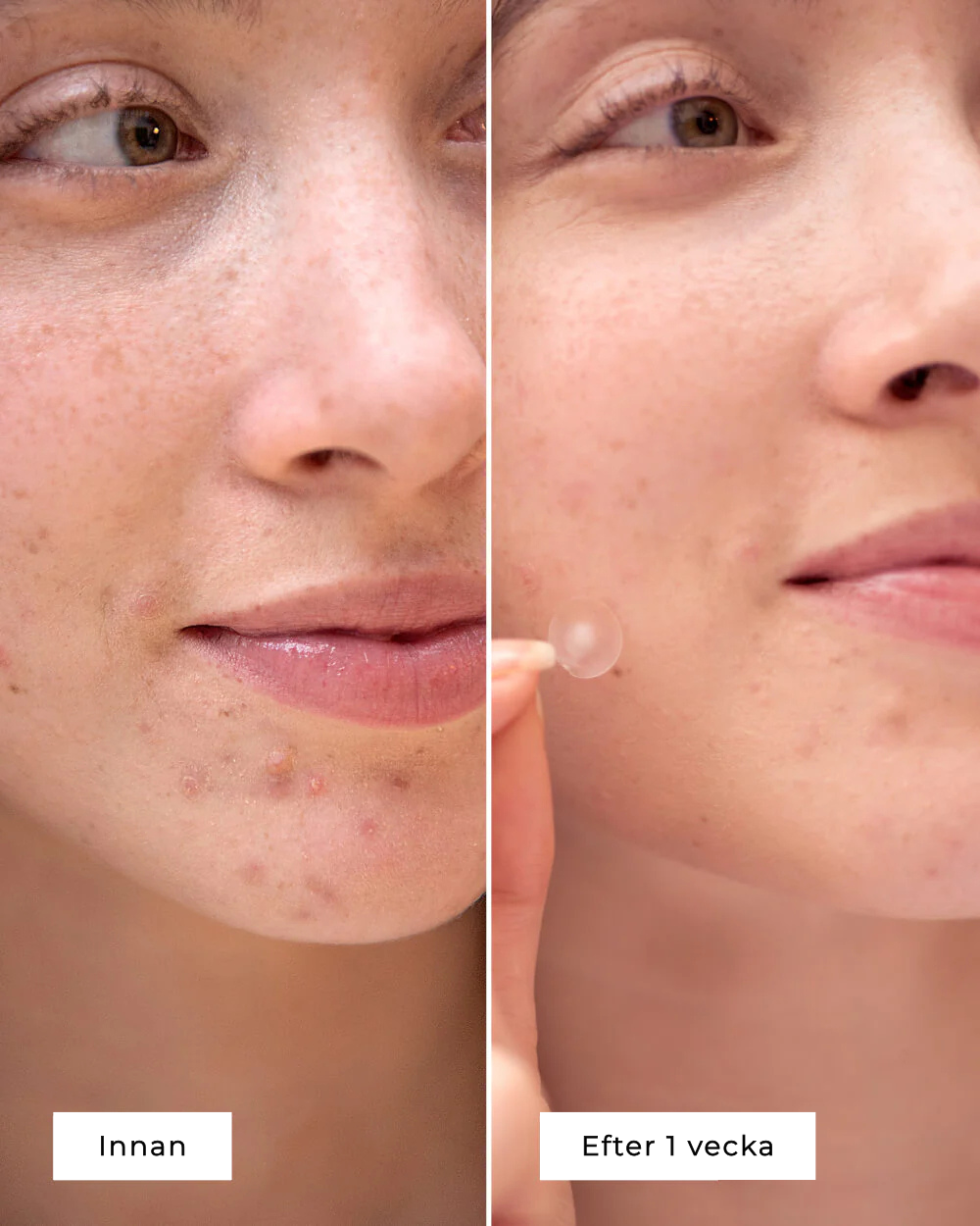CLEAR SPOT PATCHES