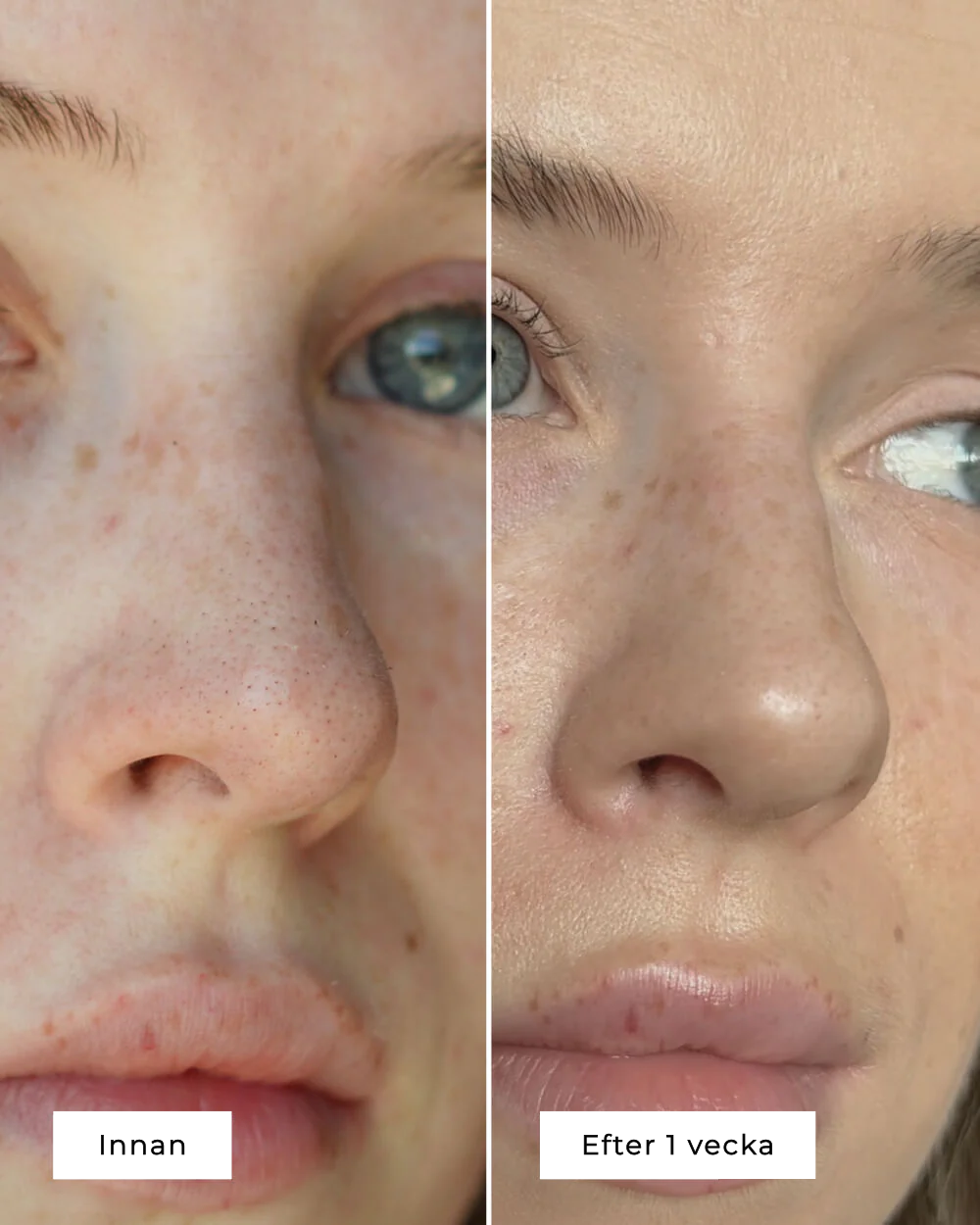 NOSE PATCHES